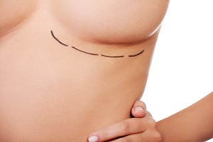 breast augmentation patient